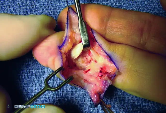 HEMANGIOMA Surgical Diagram