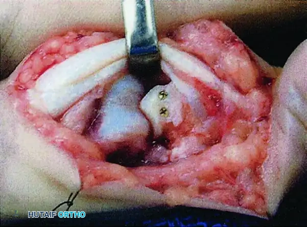 HEMI-HAMATE AUTOGRAFT Surgical Diagram