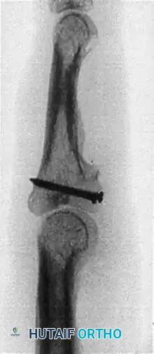 HEMI-HAMATE AUTOGRAFT Surgical Diagram