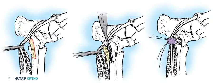 Muscle Hernias & Peroneal Tendon Displacement: Surgical Guide