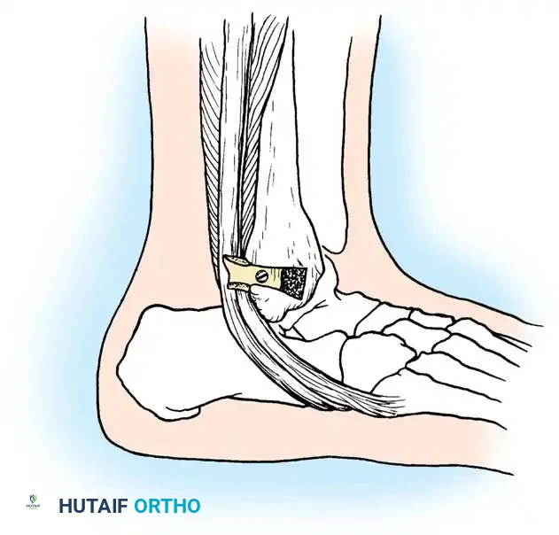 Peroneus brevis tendon