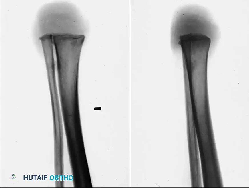 HINDFOOT AND ANKLE AMPUTATIONS Surgical Diagram