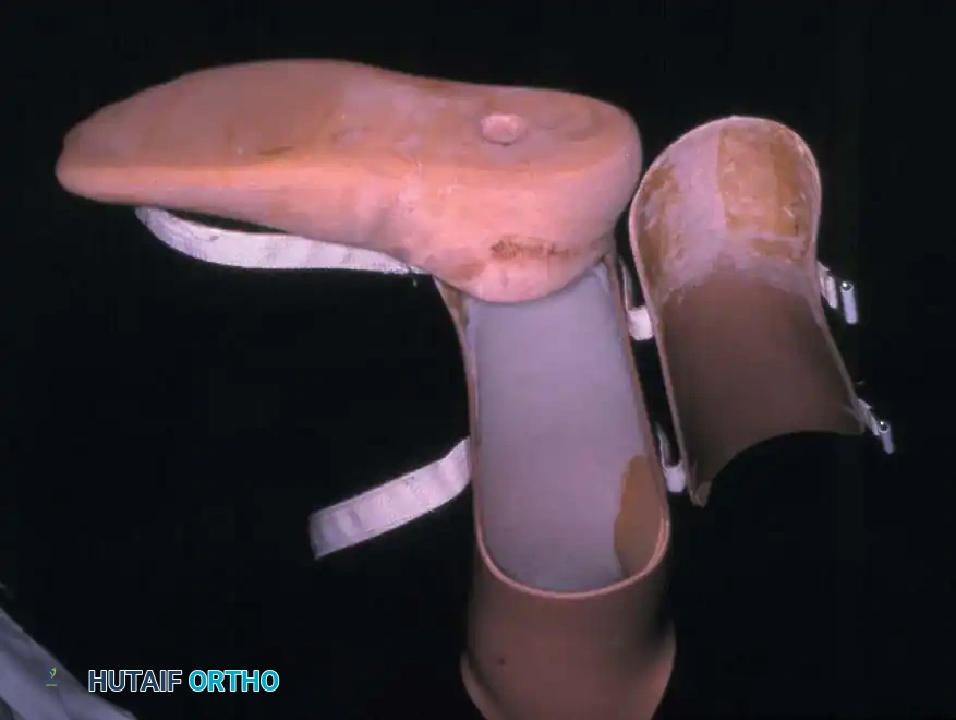 Fig. 10-18 A and B, Frontal view of Syme amputation with prosthesis (B) . C and D, Anteroposterior and lateral radiographs of Syme amputation. Note absence of malleoli.