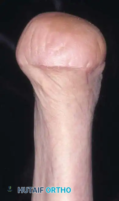 Fig. 10-18 A and B, Frontal view of Syme amputation with prosthesis (B) . C and D, Anteroposterior and lateral radiographs of Syme amputation. Note absence of malleoli.