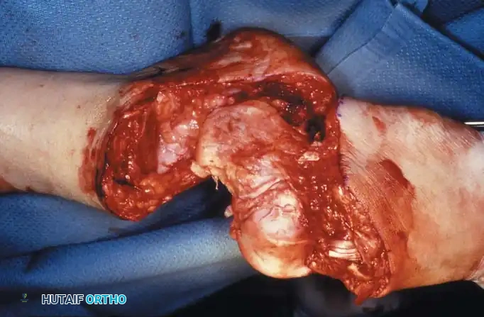 Fig. 10-19 Syme amputation. A, Incision and bone level. B, Exposure of ankle and division of ligaments. C, Bone hook pulling talus distally, exposing distal articular surface of tibia and fi bula. D, Dissection of soft tissues from calcaneus. E and F, Subperiosteal removal of calcaneus, leaving heel pad intact. Continued