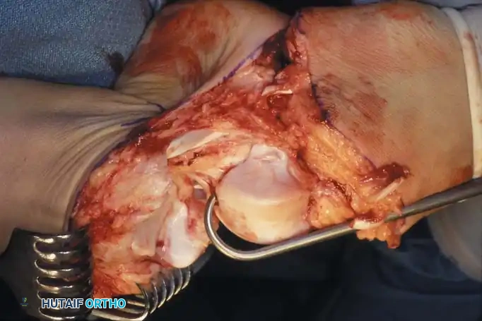 HINDFOOT AND ANKLE AMPUTATIONS Surgical Diagram