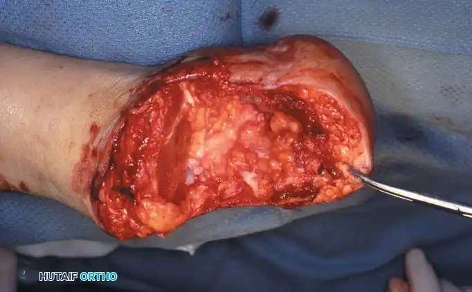 HINDFOOT AND ANKLE AMPUTATIONS Surgical Diagram