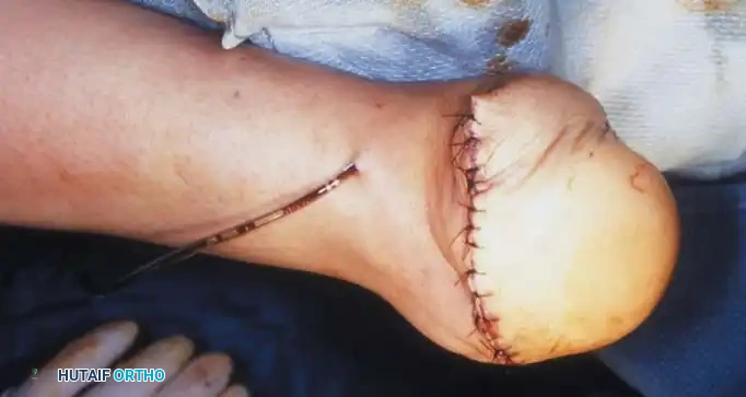 Fig. 10-19, cont’d G, Division of tibia and fi bula just through dome of ankle joint centrally. H, Holes drilled in anterior edge of tibia and fi bula to anchor heel pad. I, Edge of deep fascia lining heel pad is anchored to tibia and fi bula. J and K, Skin closure over drain, and application of above-knee cast.