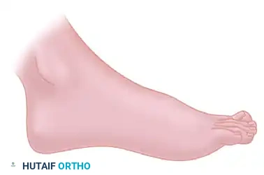 HINDFOOT Surgical Diagram
