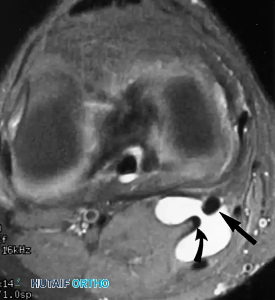 صورة تظهر كيسة الحفرة المأبضية في الركبة