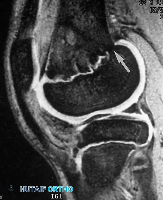 صورة تظهر حاجزا في صفيحة النمو