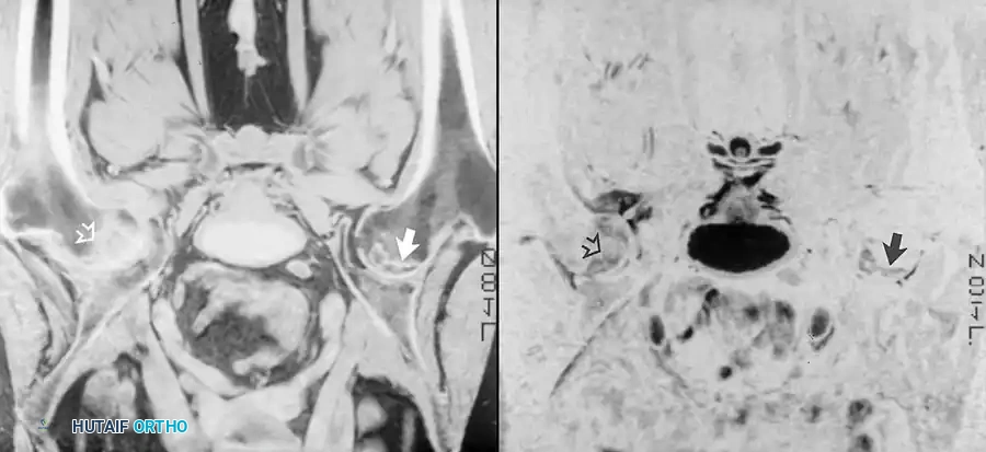 الدليل الشامل لتشخيص وعلاج أمراض مفصل الورك بالرنين المغناطيسي