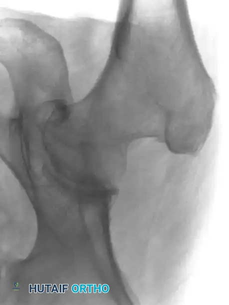 صورة تظهر كسرا خفيا في مفصل الورك الجزء الأول