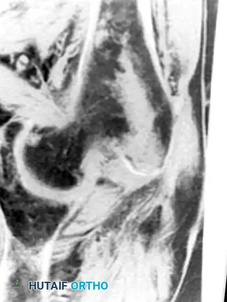 صورة تظهر كسرا خفيا في مفصل الورك الجزء الثاني