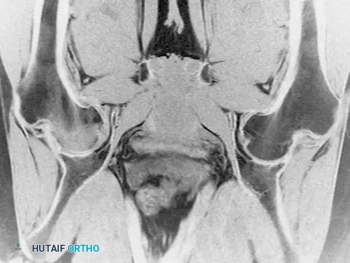 صورة توضح هشاشة العظام العابرة في الورك الجزء الأول