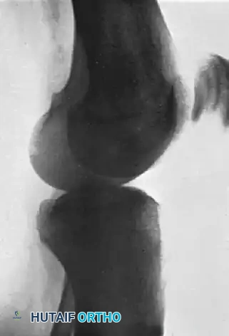 HIP Surgical Diagram