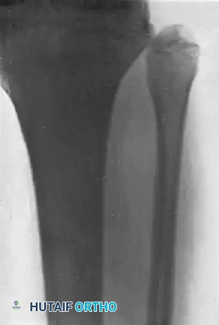 HIP Surgical Diagram