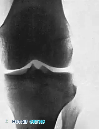 HIP Surgical Diagram