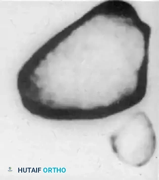 الدليل الشامل لخلع المفصل الوركي الرضحي وإصابات الطرف السفلي