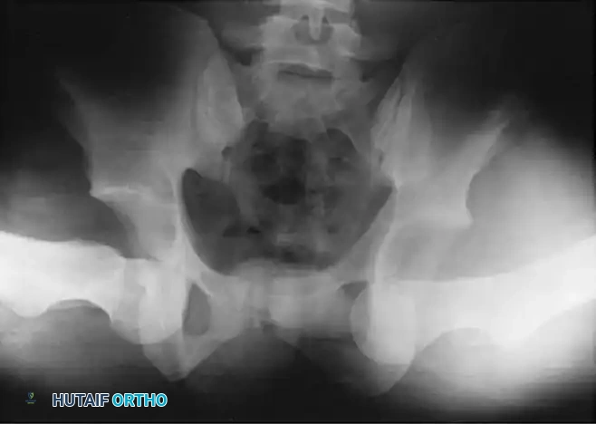 Masterclass in Traumatic Hip Dislocations and Associated Lower Extremity Injuries