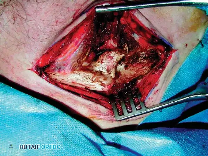 Malunion Site