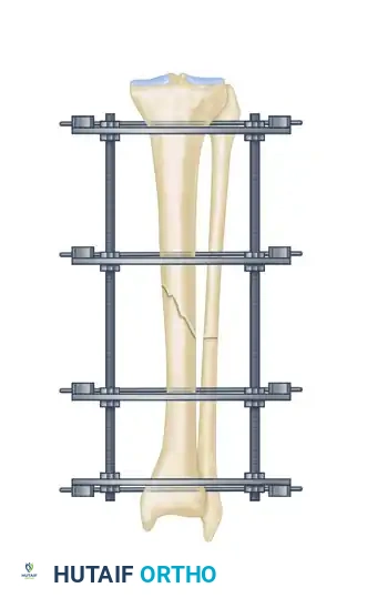 ILIZAROV EXTERNAL FIXATION FOR TIBIAL SHAFT FRACTURES Surgical Diagram