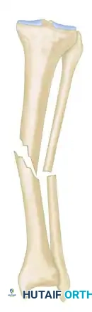 ILIZAROV EXTERNAL FIXATION FOR TIBIAL SHAFT FRACTURES Surgical Diagram