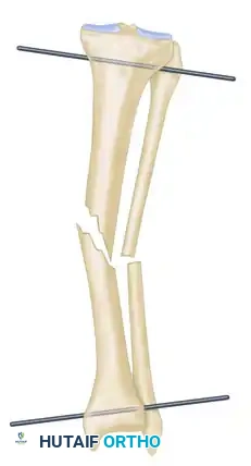 ILIZAROV EXTERNAL FIXATION FOR TIBIAL SHAFT FRACTURES Surgical Diagram