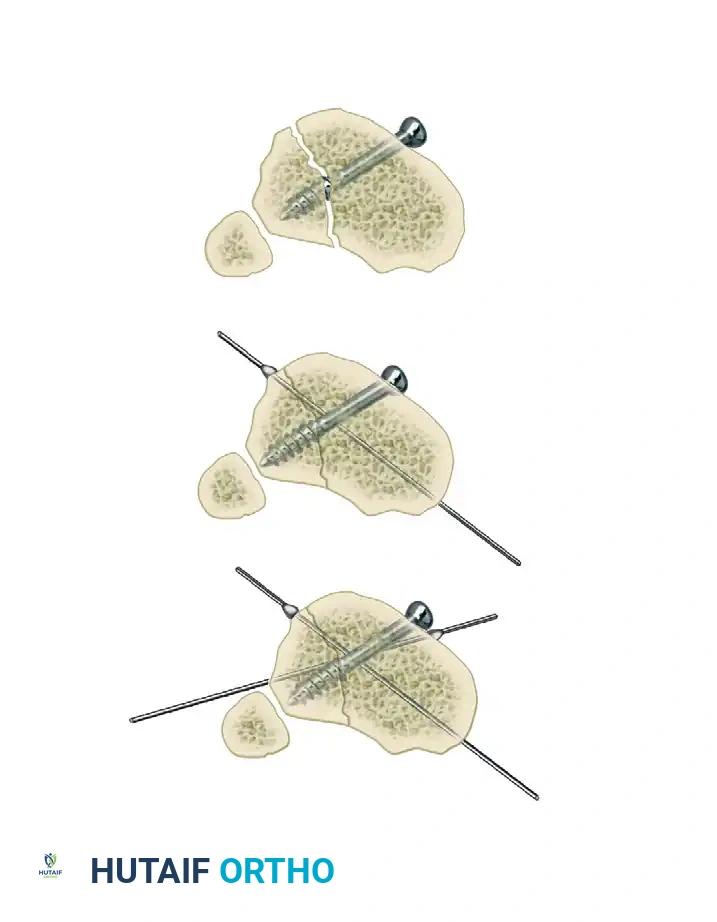 ILIZAROV EXTERNAL FIXATION FOR TIBIAL SHAFT FRACTURES Surgical Diagram