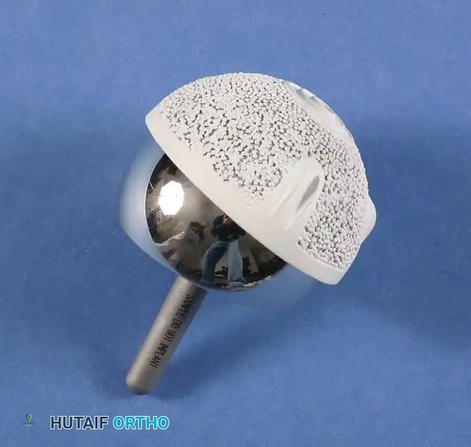 Fig. 7-39 Birmingham Hip Resurfacing implants (Smith & Nephew, Memphis, Tenn). Cast cobalt-chromium alloy implants. Femoral component is fi xed with cement. Acetabular shell has cast porous surface with hydroxyapatite coating.