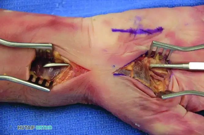 INFECTIONS OF RADIAL AND ULNAR BURSAE Surgical Diagram