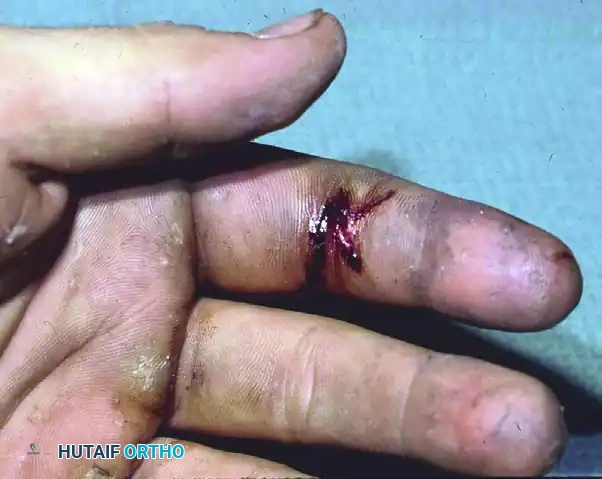 Comprehensive Surgical Management of Upper Extremity Injection, Extravasation, and Wringer Injuries