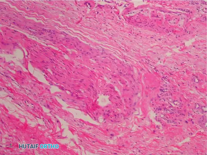 Fig. 83-7 Pathological fi ndings of interdigital neuroma. D, Small bursa may be found in region (hematoxylin and eosin stain).