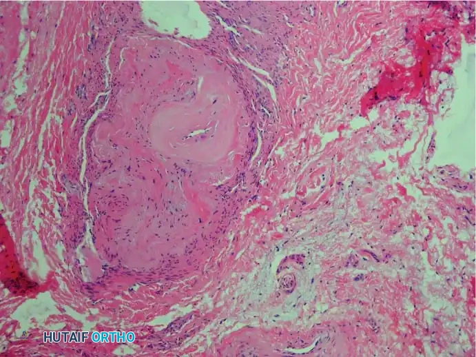 Fig. 83-7 Pathological fi ndings of interdigital neuroma. A, Interdigital nerve is greatly thickened by perineural fi brous tissue (hematoxylin and eosin stain).