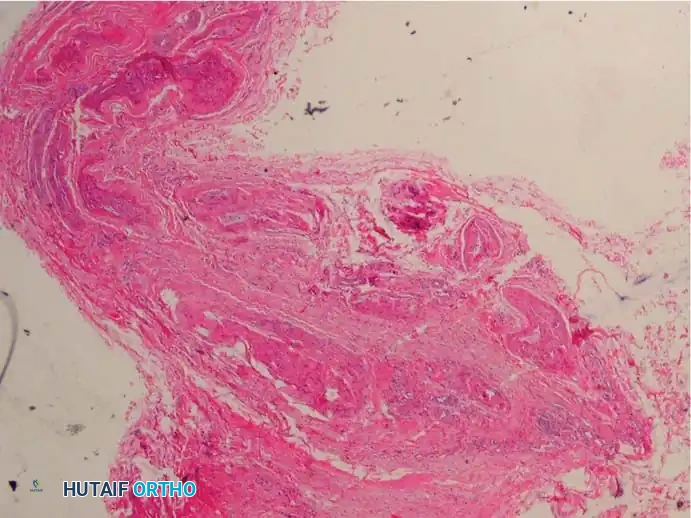 Fig. 83-7 Pathological fi ndings of interdigital neuroma. B, Vessels in region often show degenerative changes such as fraying and duplication of internal elastic lamina (Verhoeff-van Gieson stain).