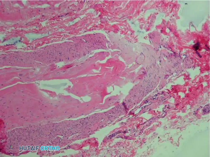Fig. 83-7 Pathological fi ndings of interdigital neuroma. C, Some axons are missing, and others show degenerative changes (Bielschowsky stain).