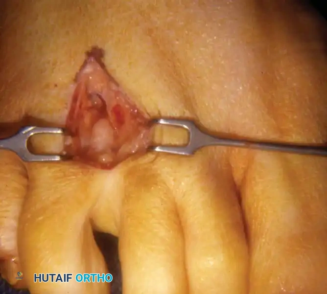 Surgical photo of dorsal approach with retractor