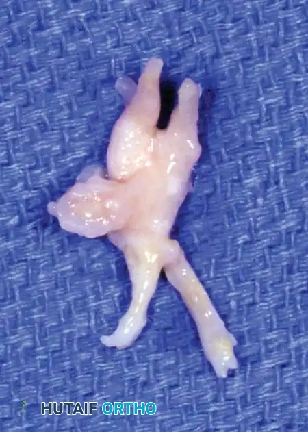 Gross specimen of excised interdigital neuroma
