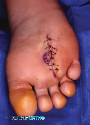Sutured plantar incision
