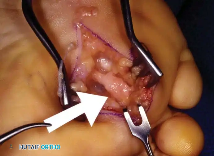 Surgical photo exposing the neuroma via plantar approach