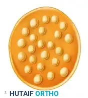 Polyfascicular without group arrangement