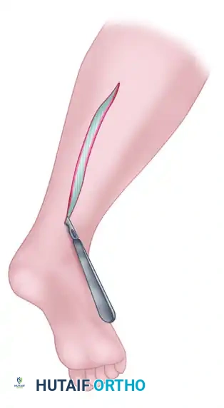 Lesser saphenous vein Sural nerve