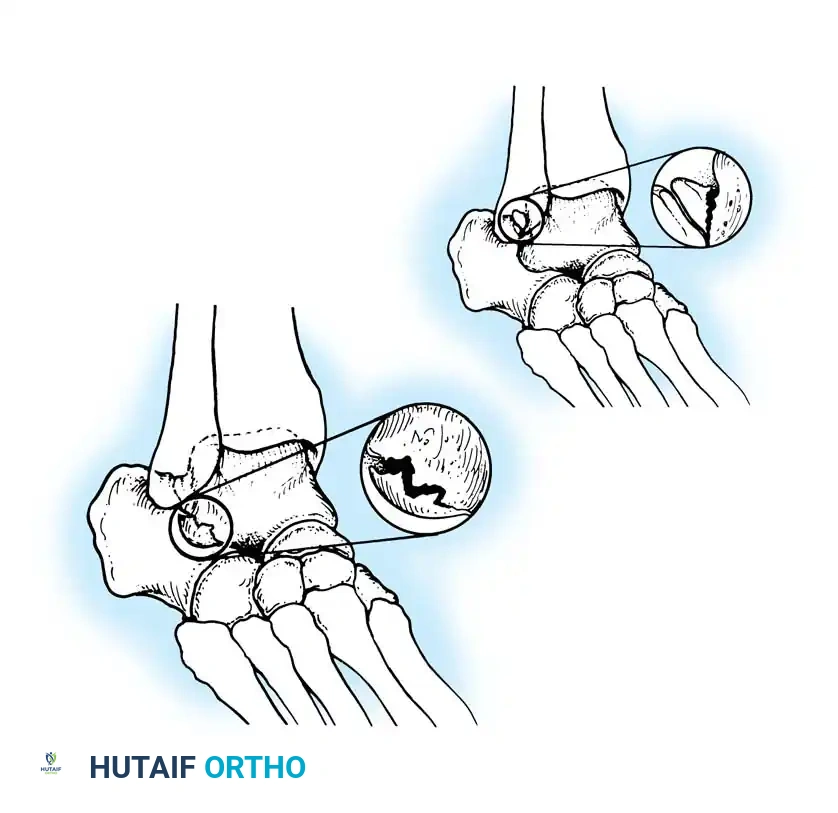 INTERNAL DERANGEMENTS Surgical Diagram