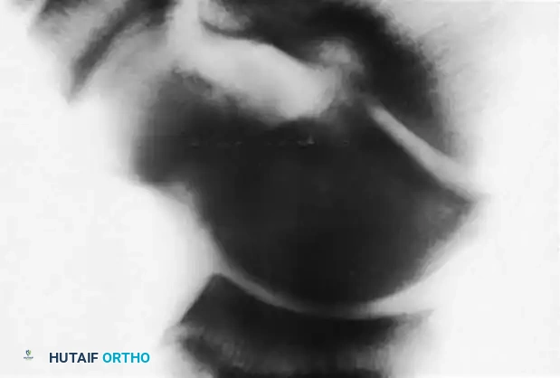 INTERNAL DERANGEMENTS Surgical Diagram