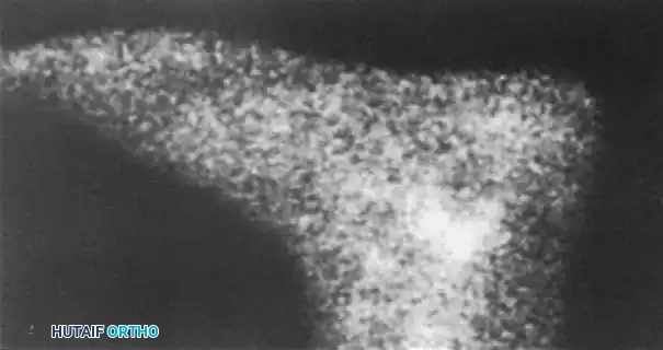 INTERNAL DERANGEMENTS Surgical Diagram