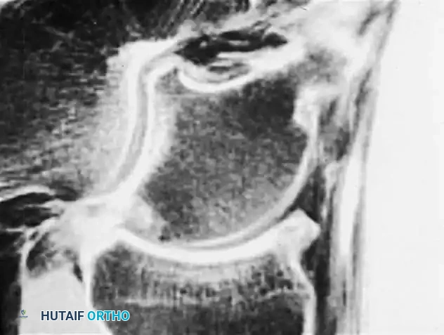 INTERNAL DERANGEMENTS Surgical Diagram