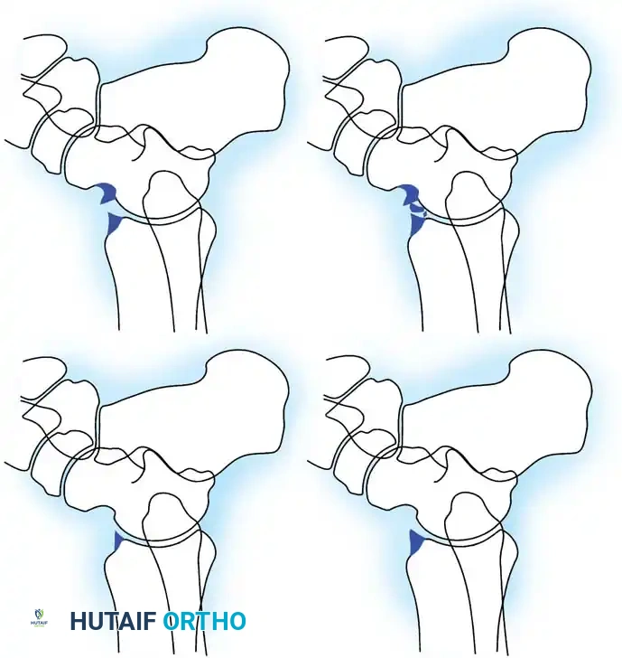 INTERNAL DERANGEMENTS Surgical Diagram