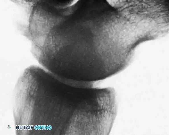 INTERNAL DERANGEMENTS Surgical Diagram