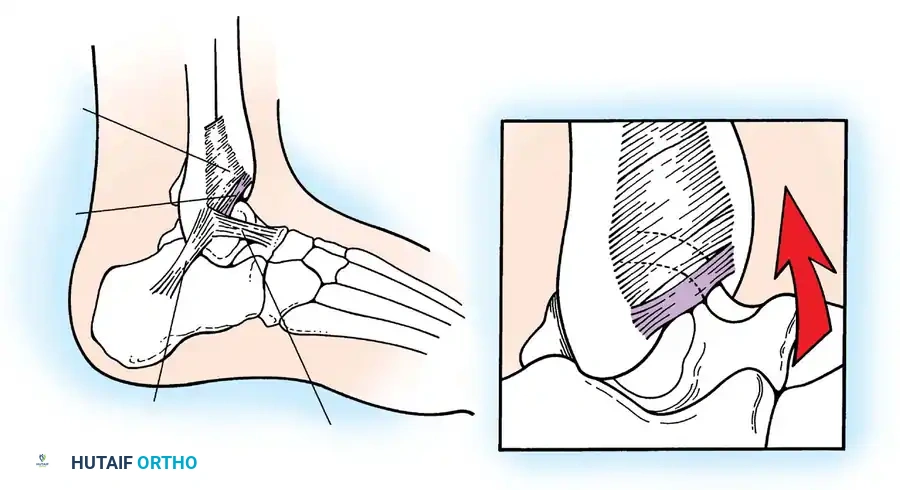 Anterior inferior tibiofibular ligament