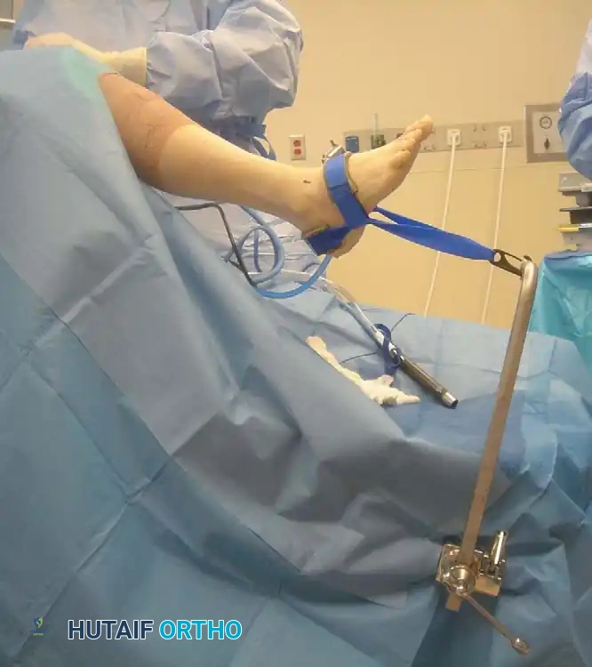 INTERNAL DERANGEMENTS Surgical Diagram